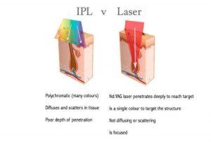 Critical difference between Laser hair removal and IPL