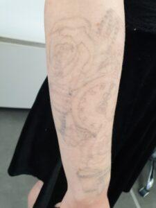 Effective Laser Tattoo Removal