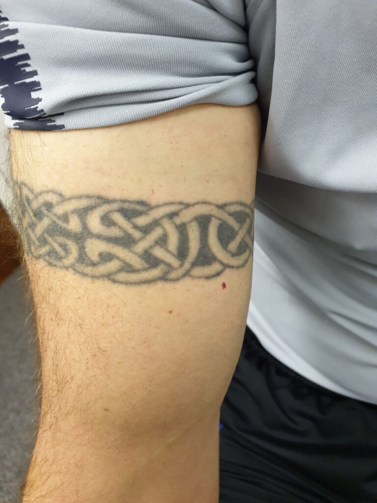 Laser Tattoo Removal image