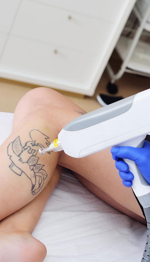 Without a Trace Laser Clinic - Tattoo Removal Tamworth